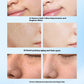 Red And Blue Light Therapy Device Acne Remover Face