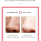 Facial Blackhead Acne Beauty Instrument